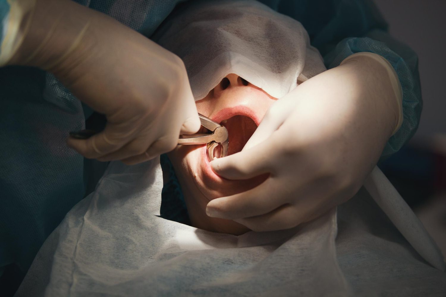 Tooth Extraction and Surgery